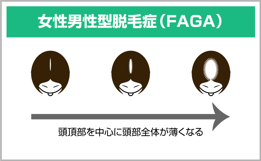 女性男性型脱毛症（FAGA） 頭頂部を中心に頭部全体が薄くなる