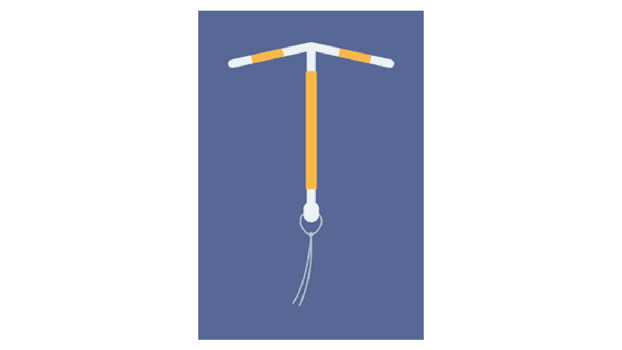 IUD（子宮内避妊具）　避妊方法