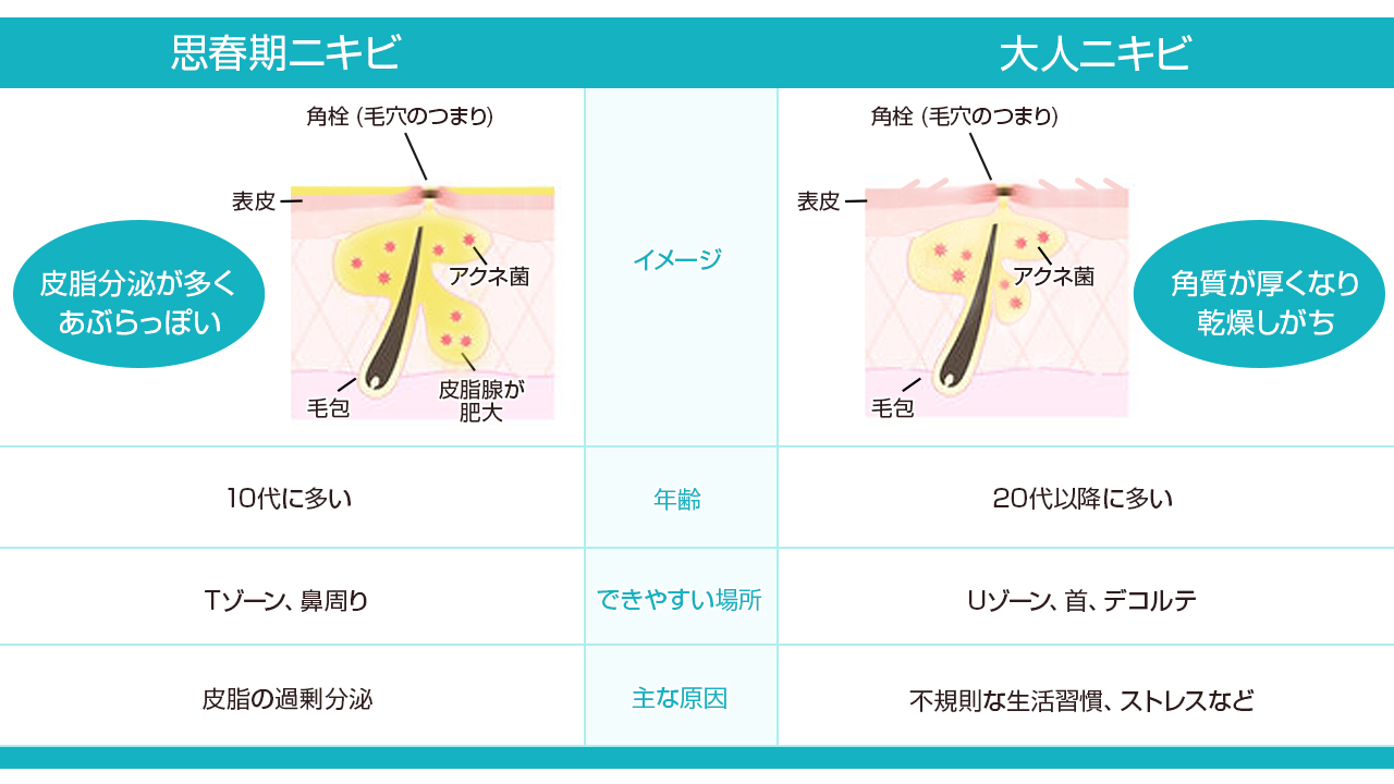 年代で見分ける│ニキビの種類・症状