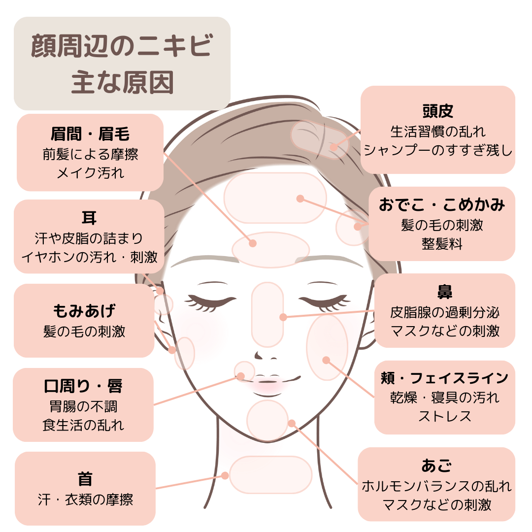 頭皮・おでこ・頬・あご・首など、場所別のニキビの原因を示した図