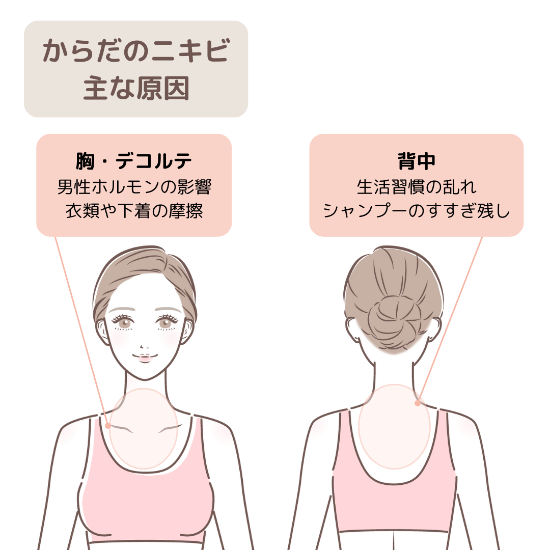 胸・デコルテ、背中など、場所別のニキビの原因を示した図
