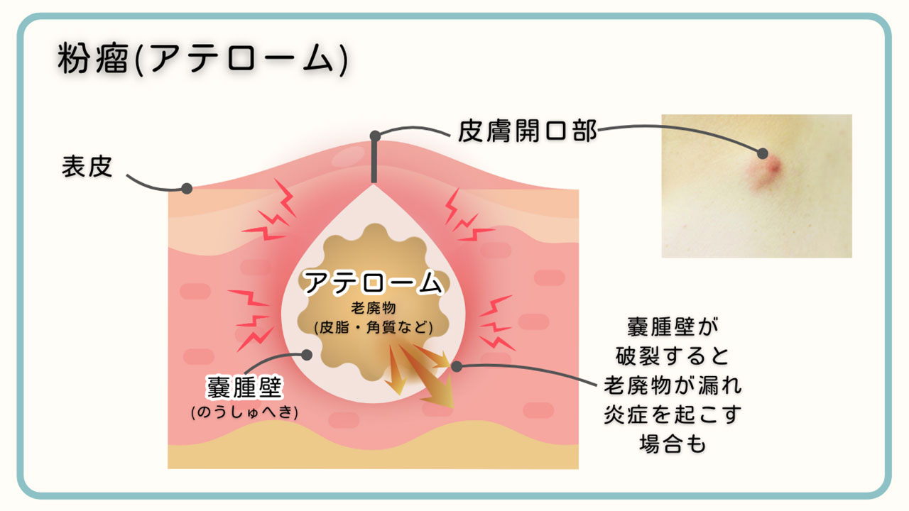 もみあげにしこりがあるなら別疾患の可能性も