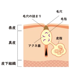 メイクや汚れが残る 汗や皮脂と混ざって角栓ができる