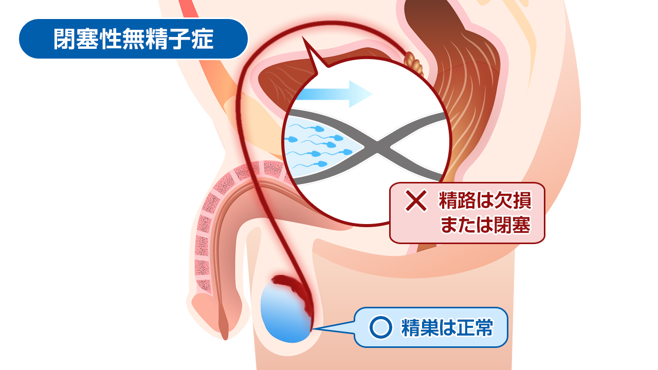 閉塞性無精子症