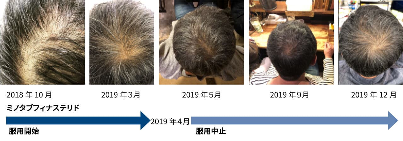 【画像あり】55歳男性Kさんの経過観察