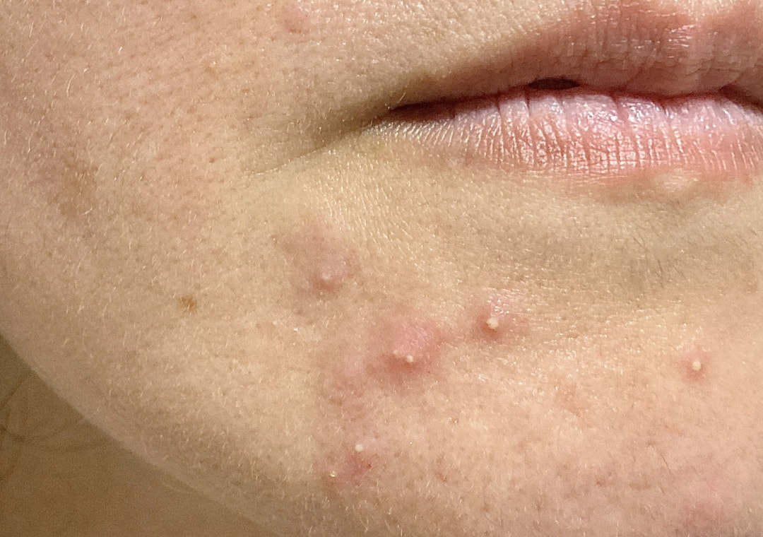 重症ニキビイメージ