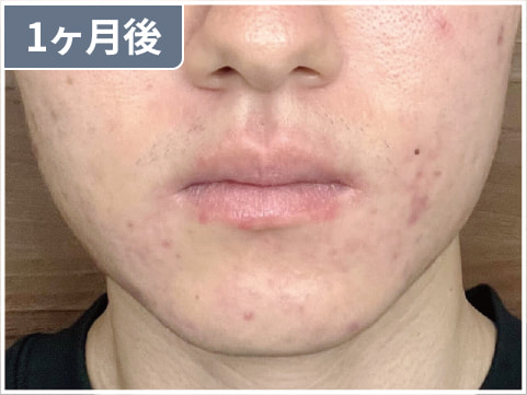 男性のイソトレチノイン症例写真：1ヶ月後