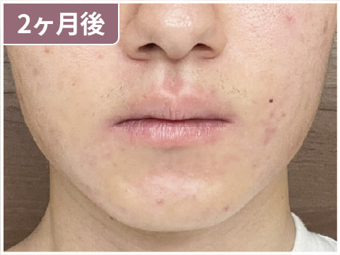 男性のイソトレチノイン症例写真：2ヶ月後