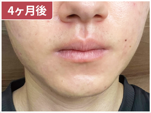 男性のイソトレチノイン症例写真：4ヶ月後