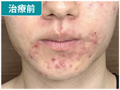 男性のイソトレチノイン症例写真：治療前
