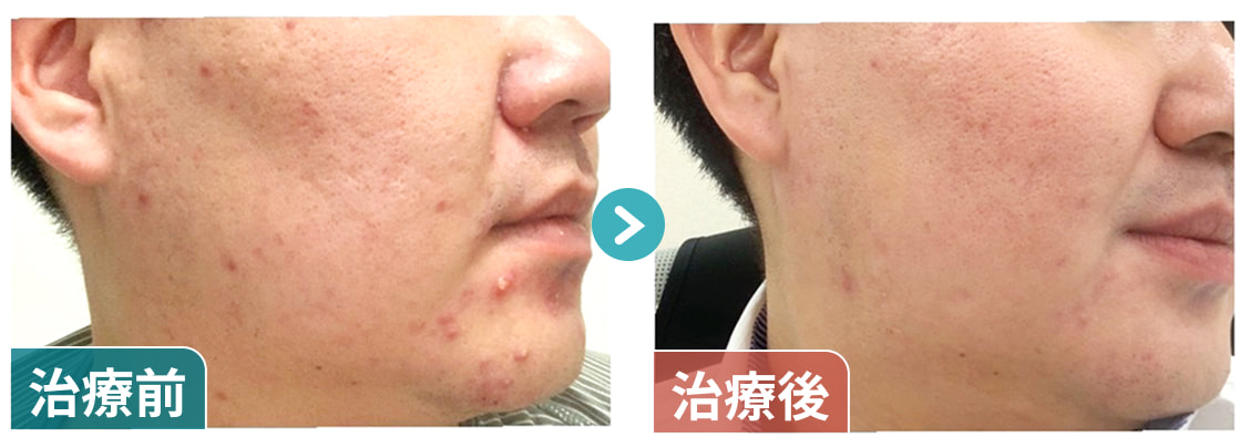 ニキビ改善01