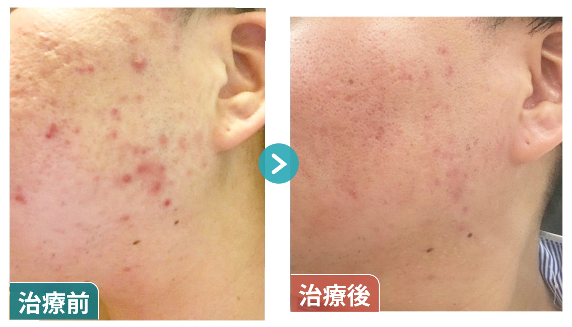 ニキビ改善02