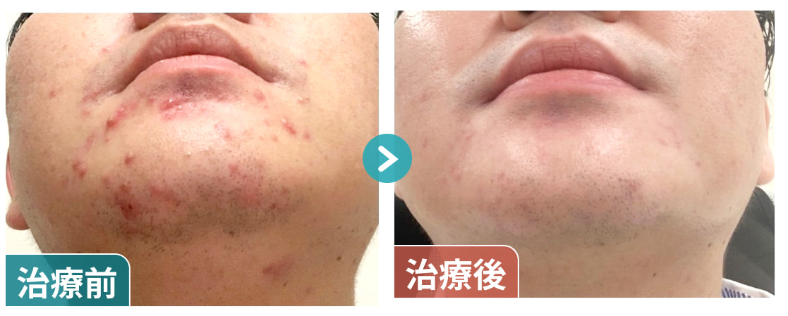 ニキビ改善03