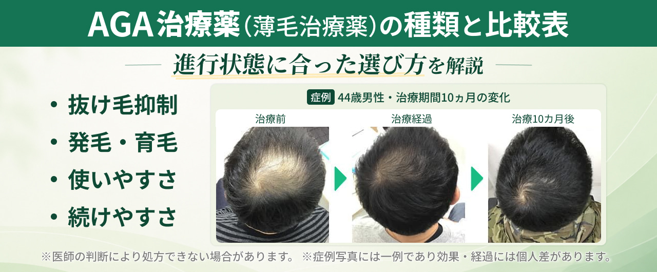 AGA治療薬（薄毛治療薬）の種類と比較表・進行状態に合った選び方を解説