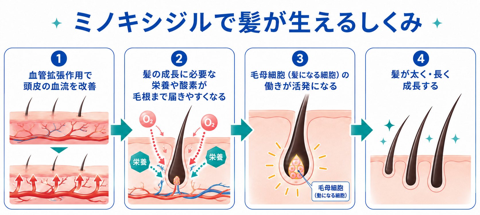ミノキシジルで髪が生えるしくみ｜①血管拡張作用で頭皮の血流を改善②髪の成長に必要な栄養や酸素が毛根まで届きやすくなる③毛母細胞（髪になる細胞）の働きが活発になる④髪が太く・長く成長する