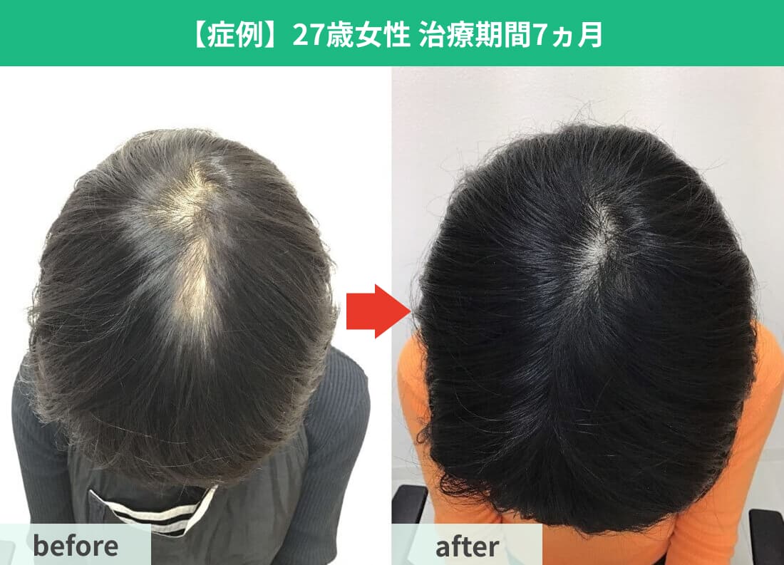 FAGA治療症例