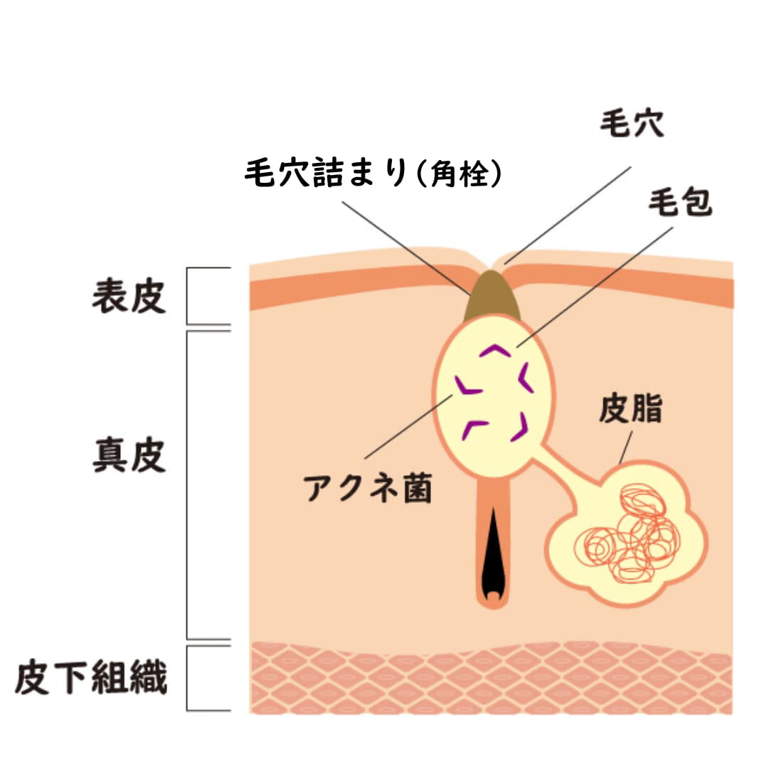 毛穴の詰まり（角栓）とアクネ菌増殖を示す断面図。表皮・真皮・皮下組織の構造とともに毛穴、皮脂、アクネ菌の関係を解説している。