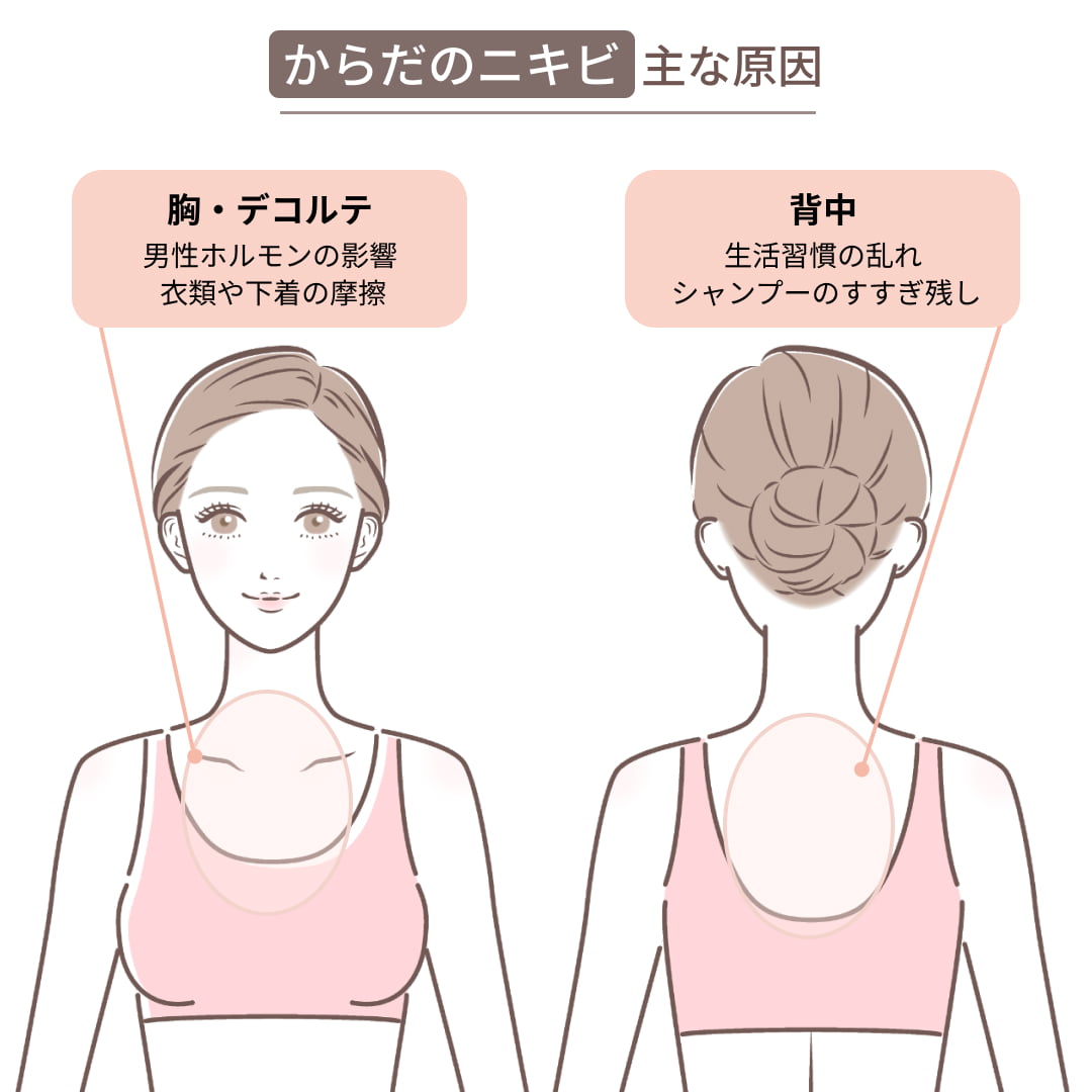 胸・デコルテ、背中など、場所別のニキビの原因を示した図