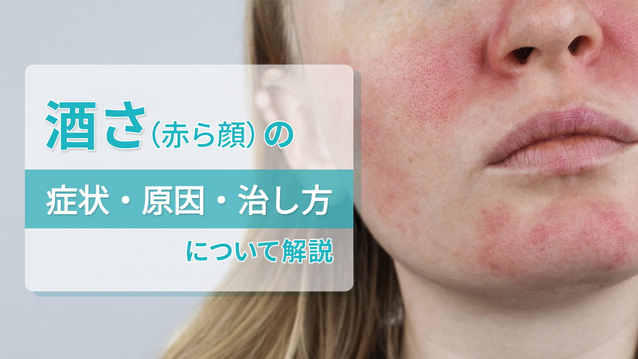 酒さ(赤ら顔)の症状・原因・治し方について解説