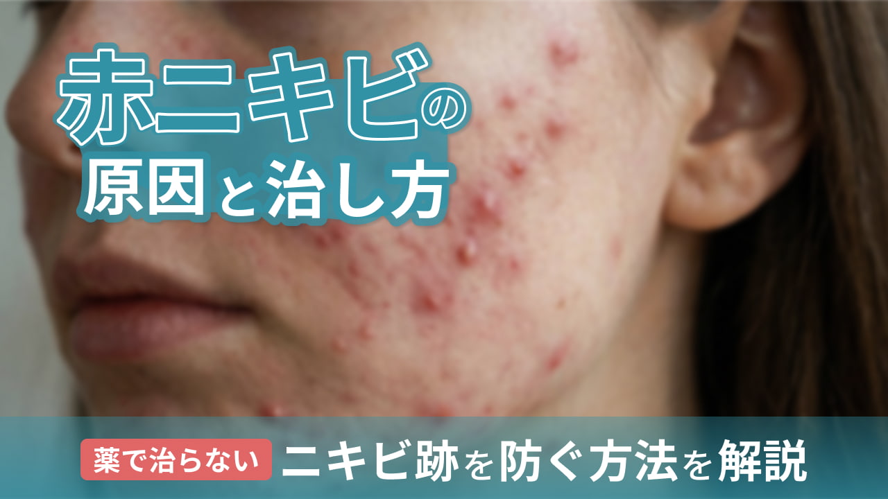 赤ニキビの原因と治し方｜薬で治らないニキビ跡を防ぐ方法を解説