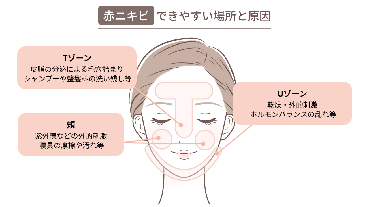 赤ニキビができやすい場所と原因,Tゾーン/皮脂の分泌による毛穴詰まり,シャンプーや整髪料の洗い残し等,Uゾーン/乾燥・外的刺激,ホルモンバランスの乱れ等,頬/紫外線などの外的刺激,寝具の摩擦や汚れ等