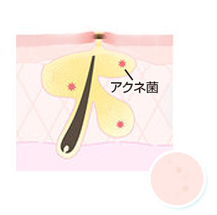 マイクロコメド