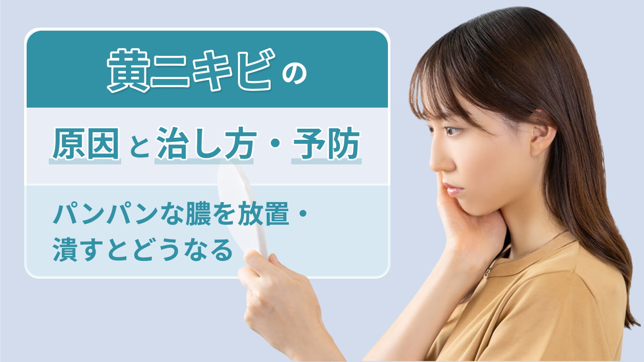 黄ニキビの原因・治し方