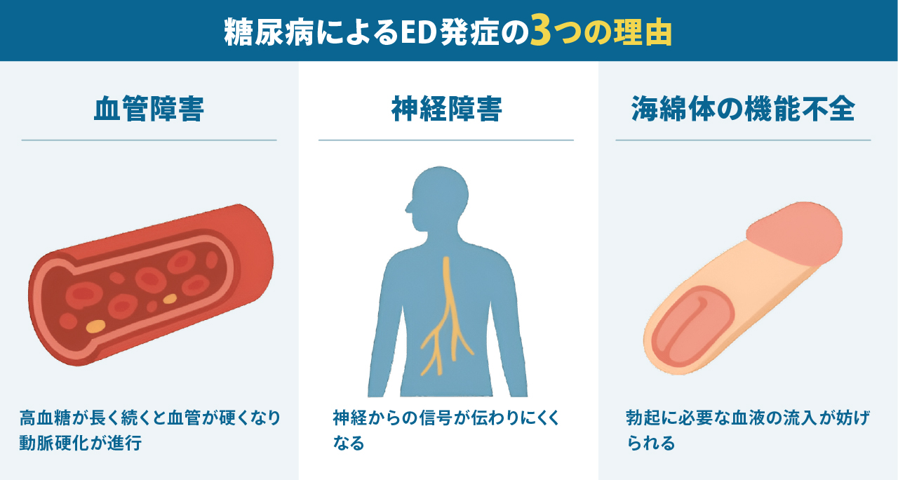 糖尿病によるED発症の3つの理由：血管障害により血管が硬くなり動脈硬化が進む、神経障害により神経信号が伝わりにくくなる、海綿体の機能不全により血液の流入が妨げられる