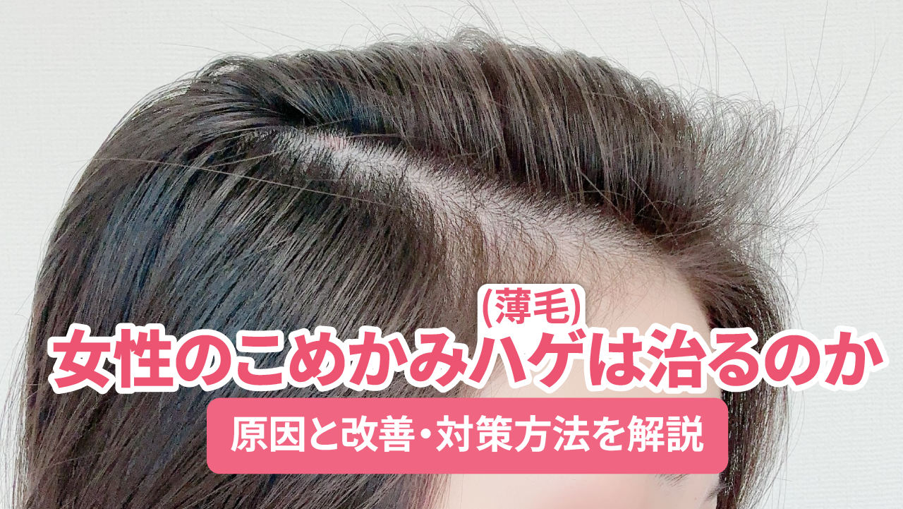 こめかみハゲ