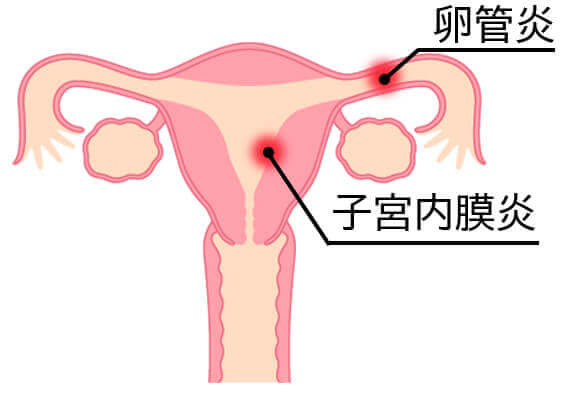 不妊症のリスクの原因