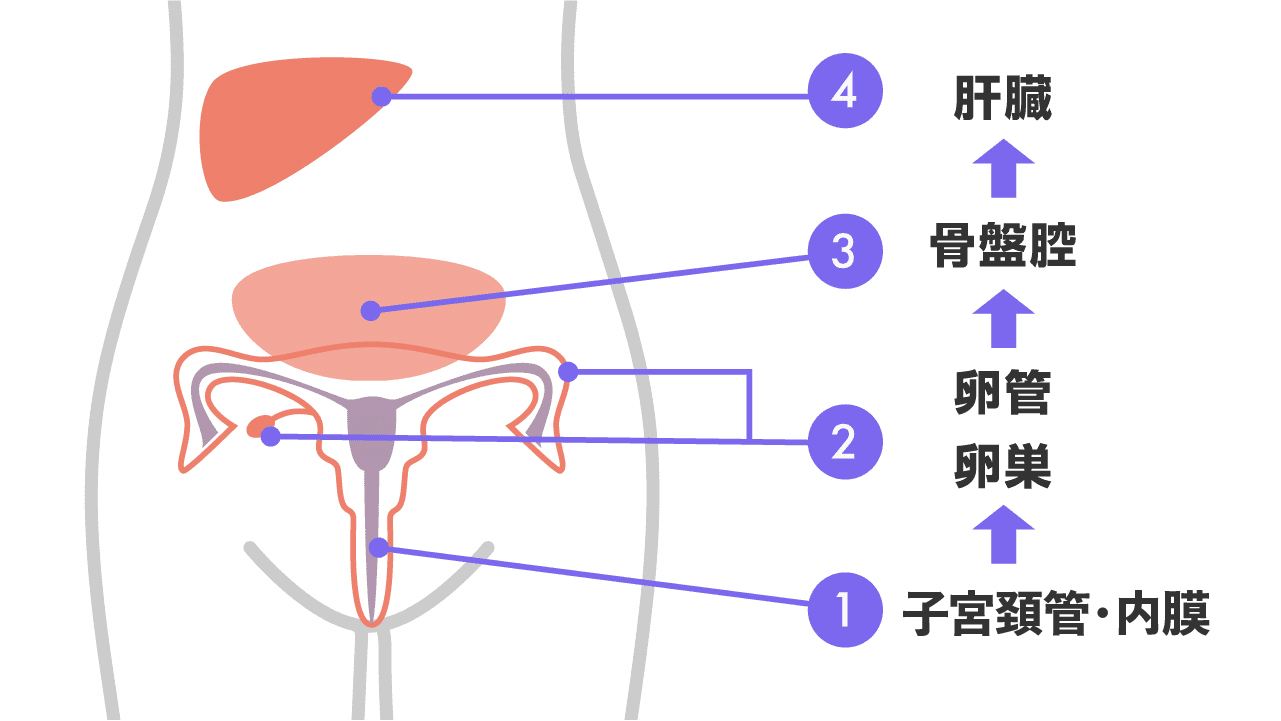 感染の拡がり❶子宮頚管・内膜❷卵管卵巣❸骨盤腔❹肝臓