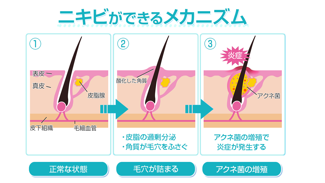 ニキビができるメカニズム