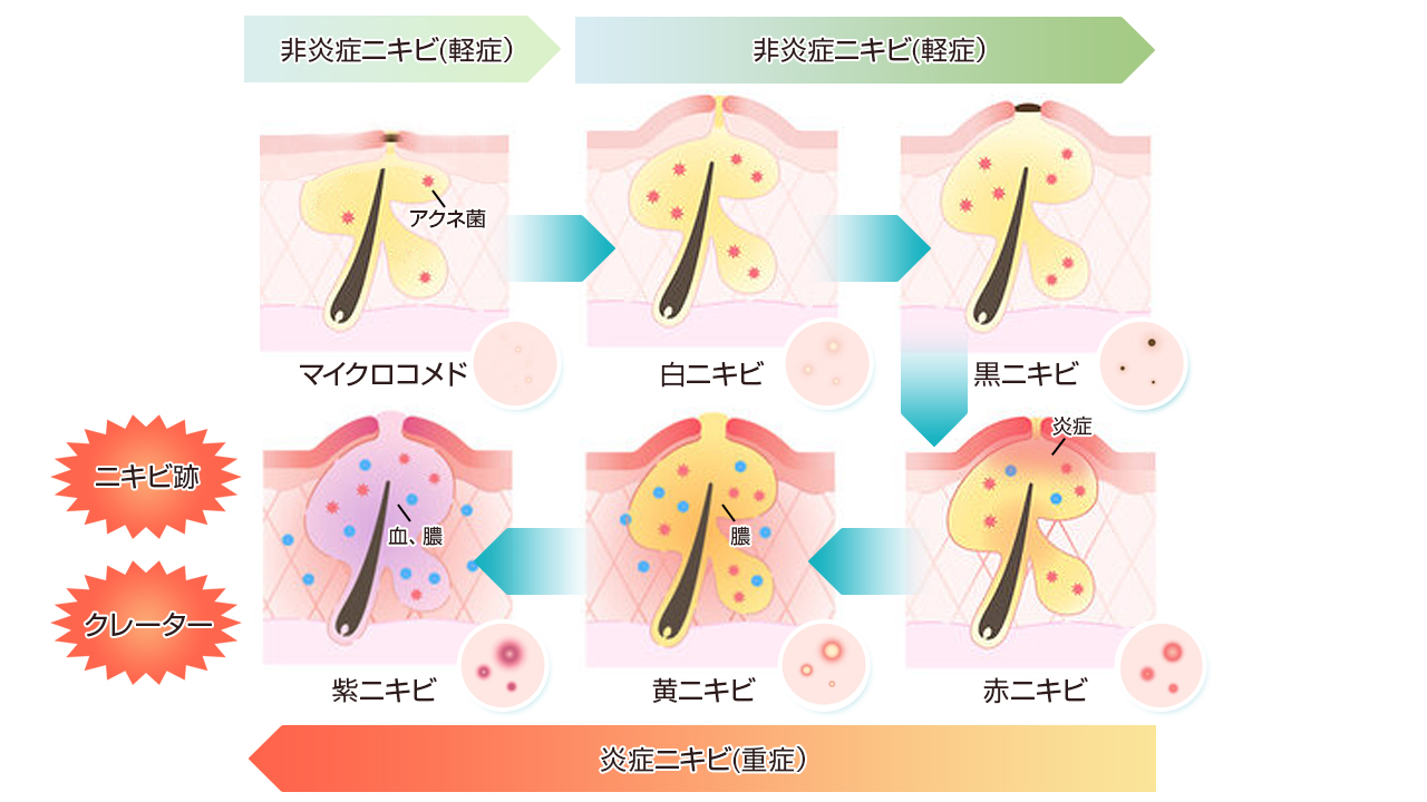 色で見分ける│ニキビの原因・種類・症状