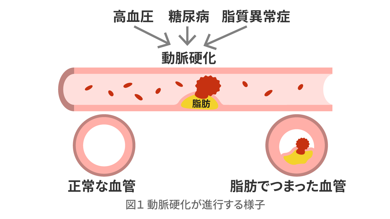 図1 動脈硬化が進行する様子 高血圧 糖尿病 脂質異常症 動脈硬化 正常な血管 脂肪でつまった血管