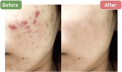 イソトレチノイン（20mg+30mg）症例写真