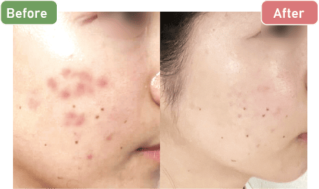 イソトレチノイン20mg症例写真