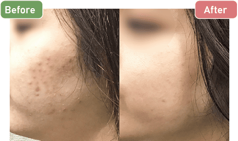 イソトレチノイン（20mg+30mg）症例写真