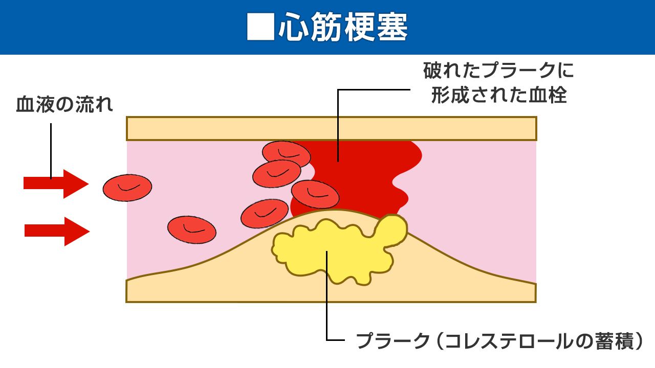 心筋梗塞