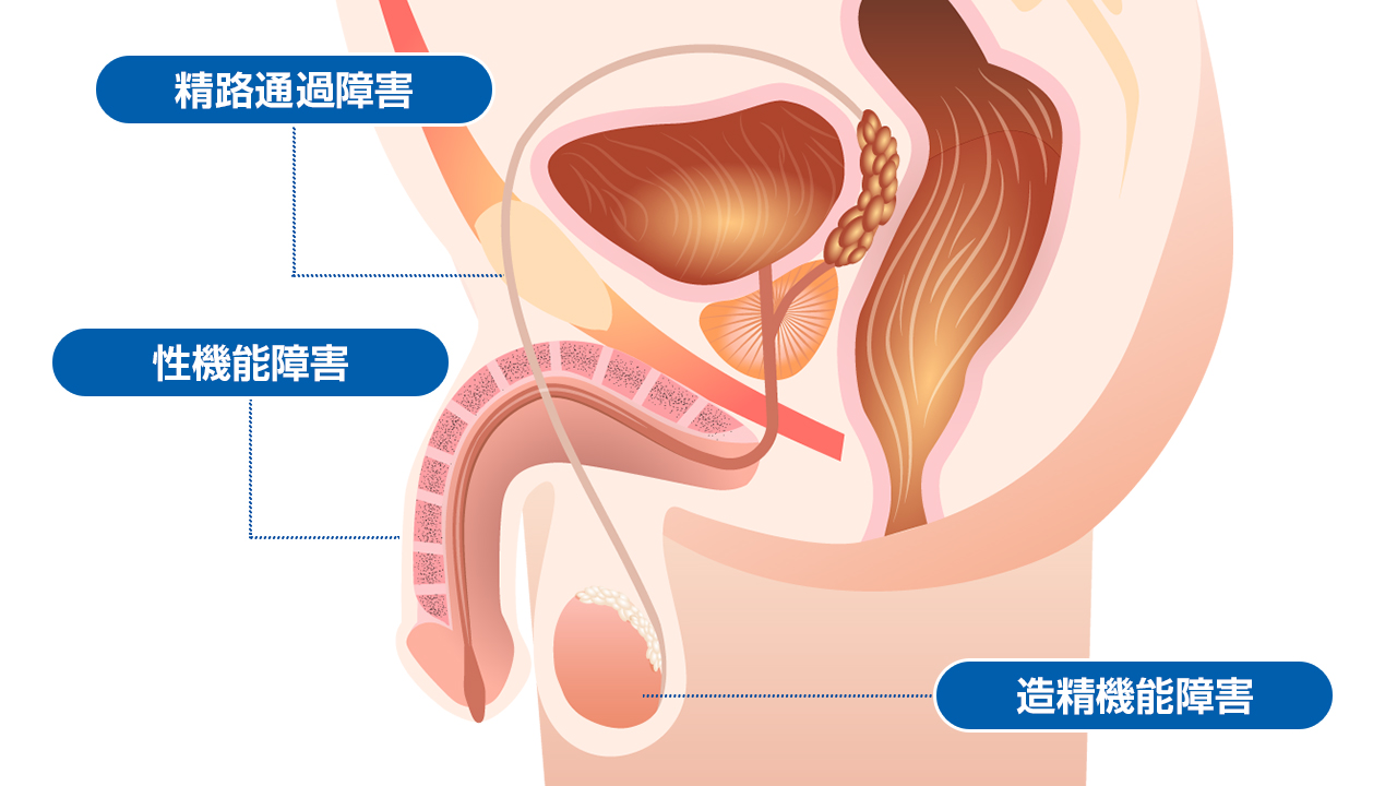男性不妊の要因となる障害