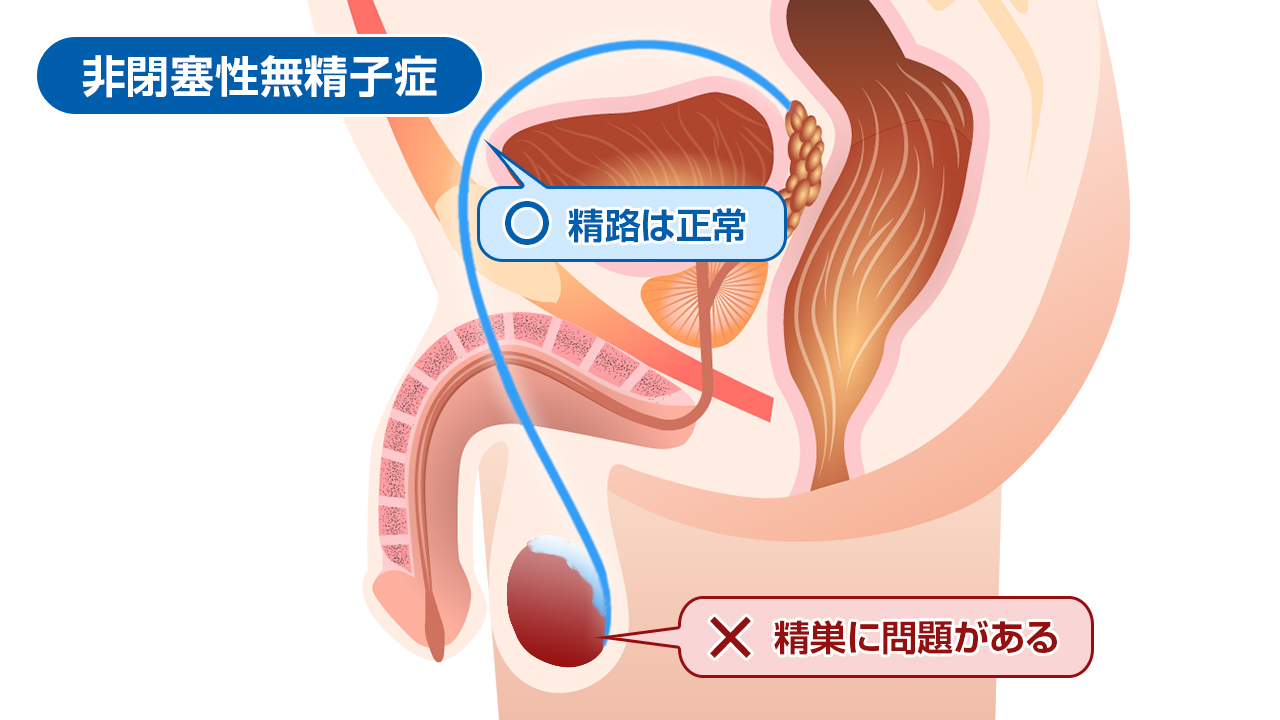 非閉塞性無精子症